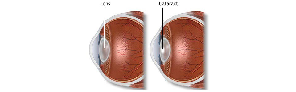 You are currently viewing Cataract