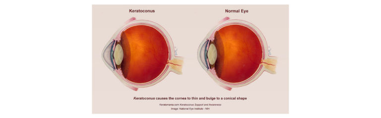 Read more about the article Keratoconus