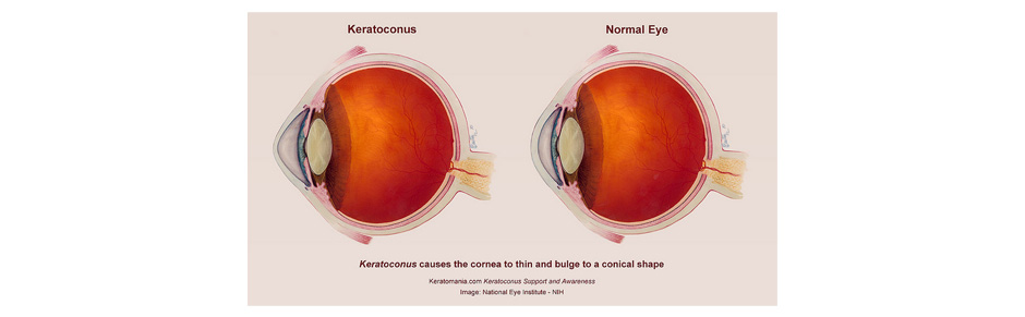 You are currently viewing Keratoconus