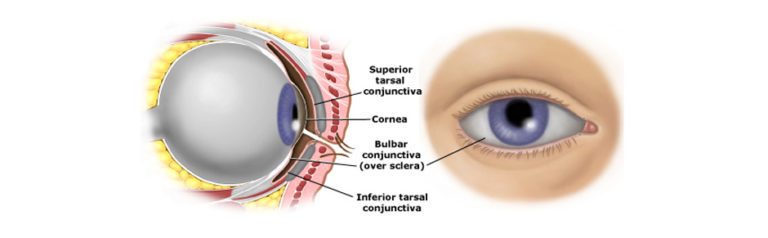 Read more about the article Strabismus